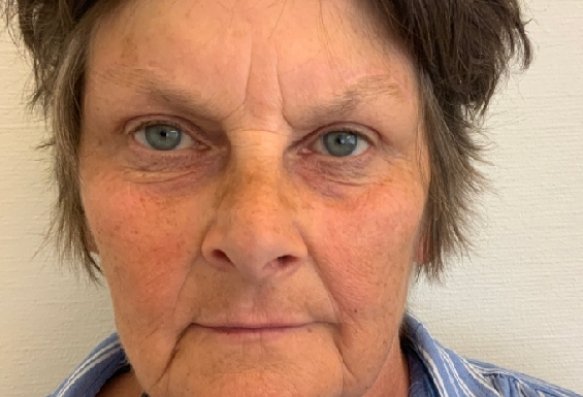 After: Wenkbrauwlift