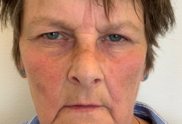 Before: Wenkbrauwlift