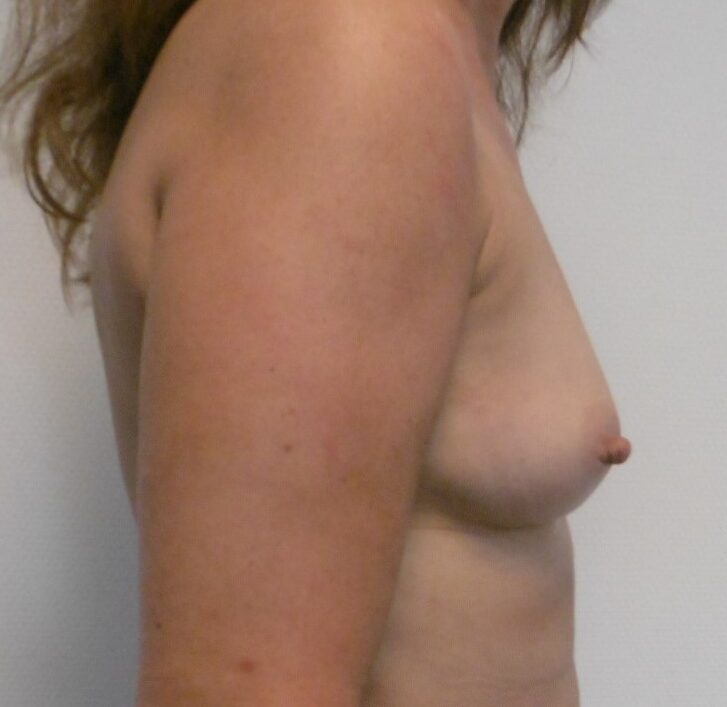 Before: Lipofilling borsten