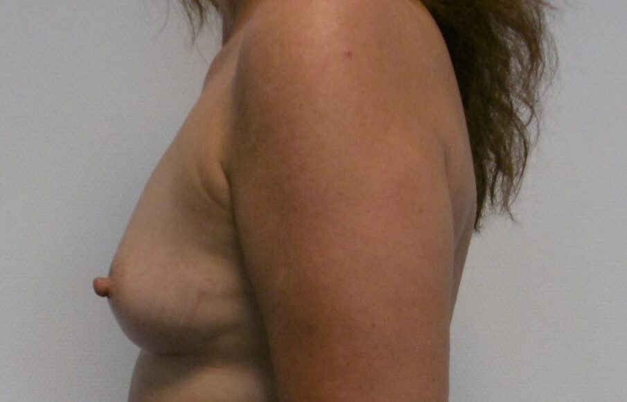Before: Lipofilling borsten