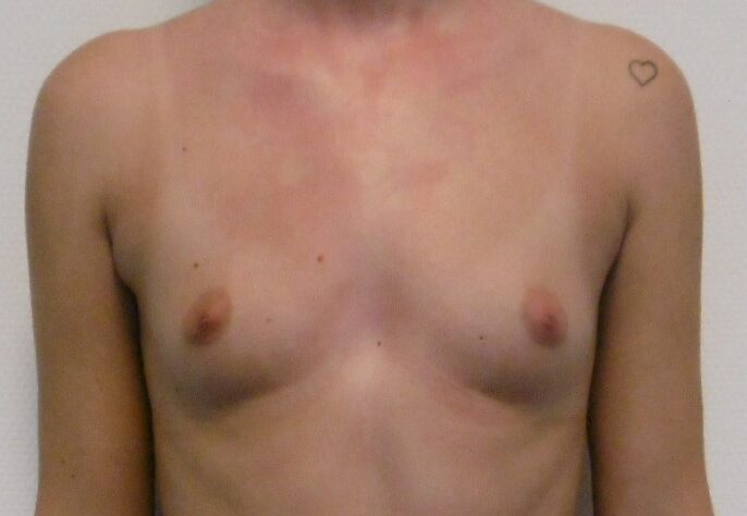 Before: Borstvergroting