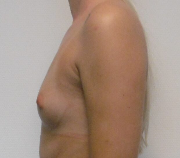 Before: Borstvergroting