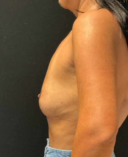 After: Borstlift