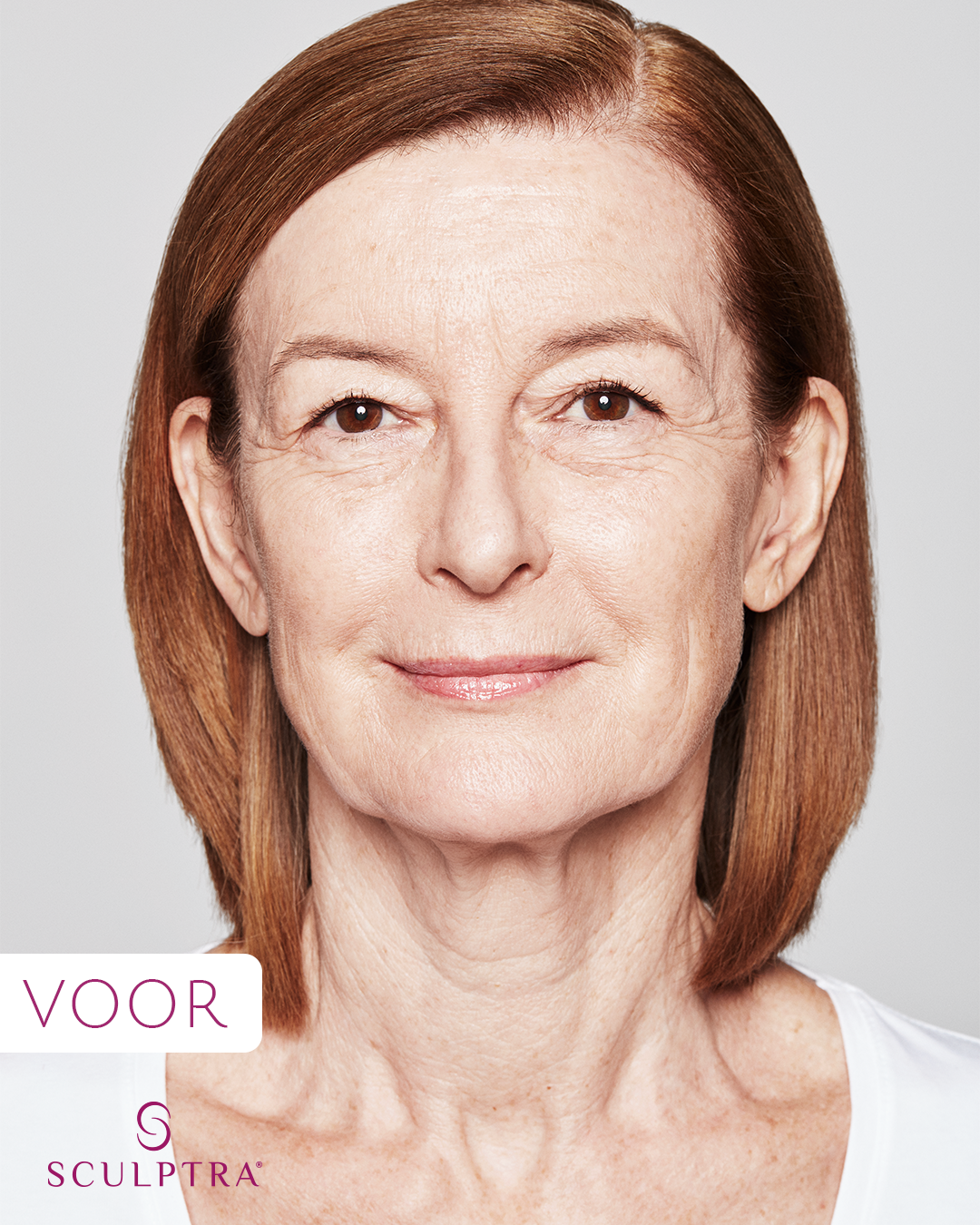 Before: Sculptra
