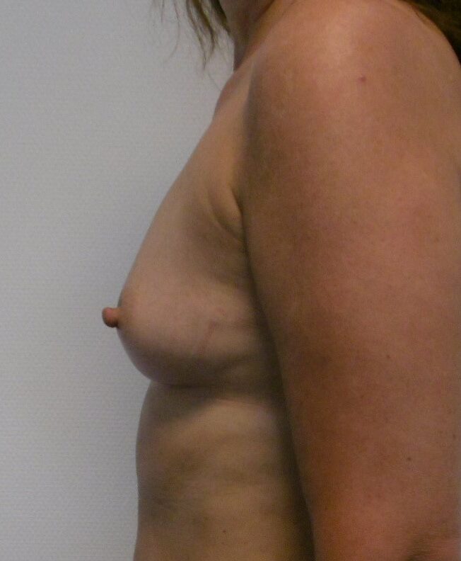 Before: Lipofilling borsten