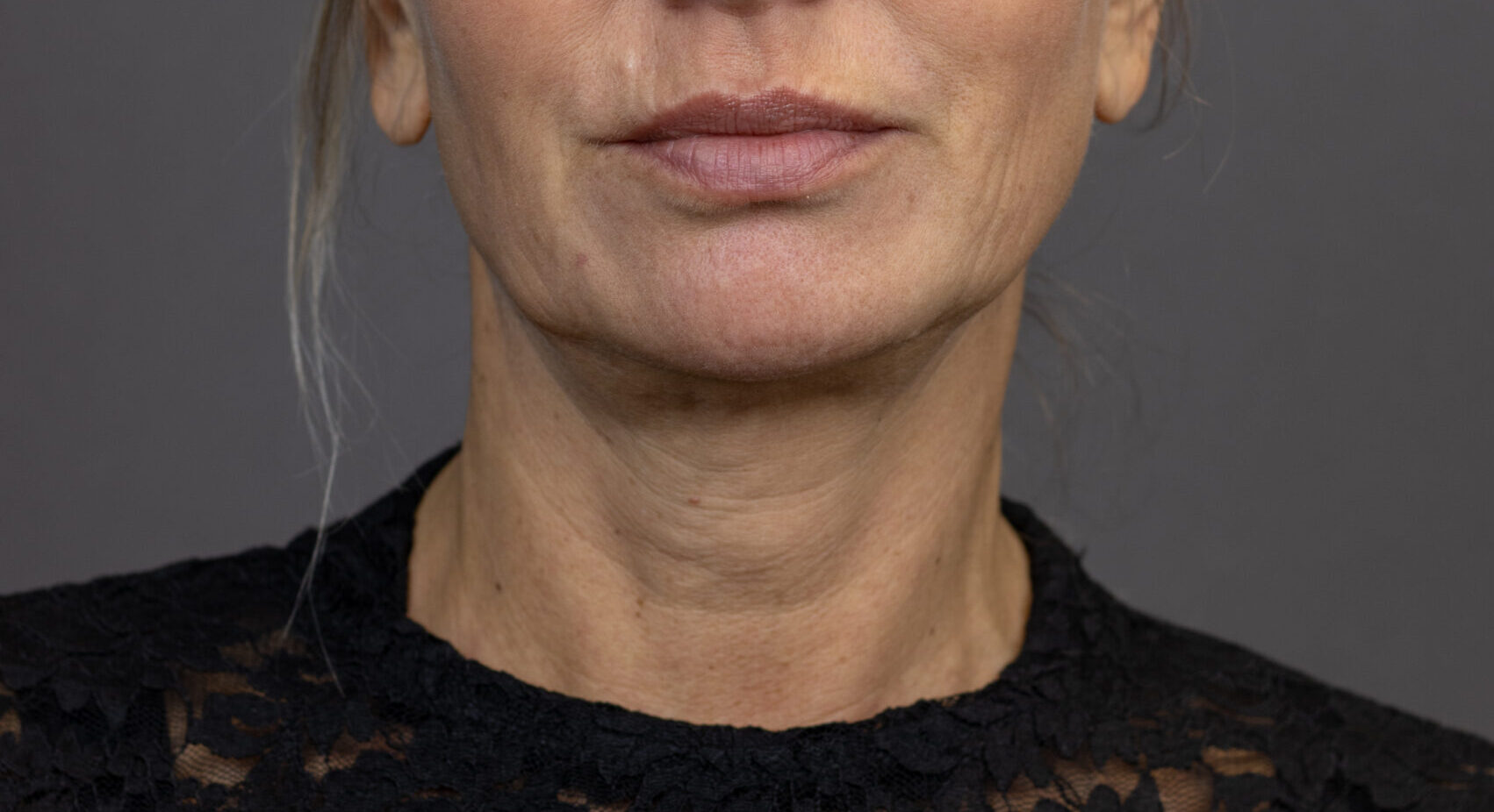 Before: Skinbooster (Injectables)