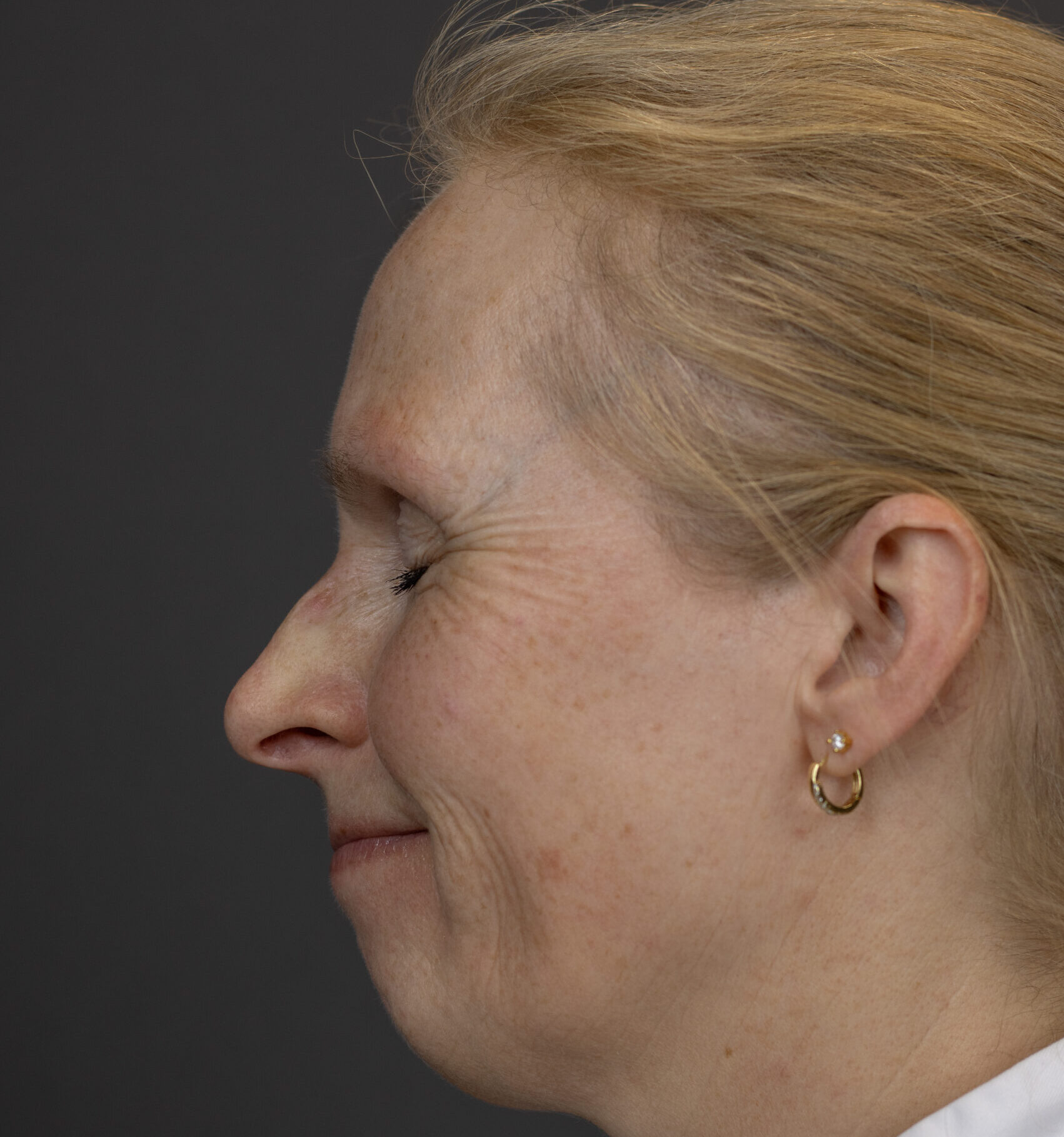 Before: Botulinetoxine