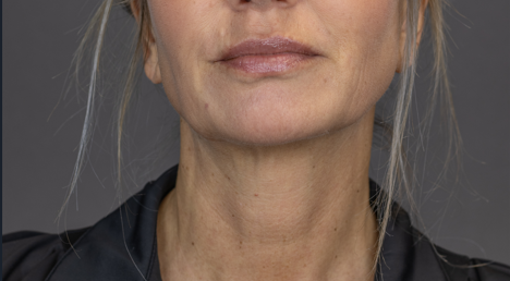 After: Skinbooster (Injectables)