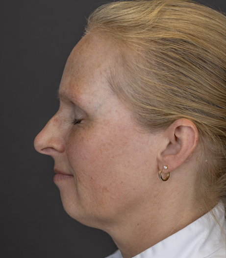 After: Botulinetoxine