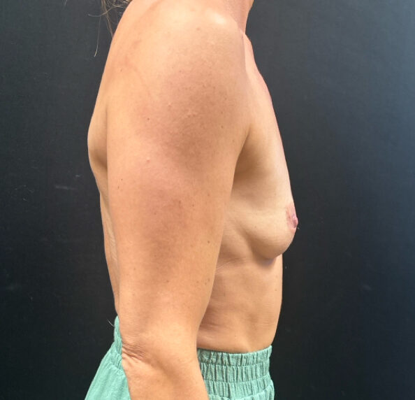 Before: Borstvergroting