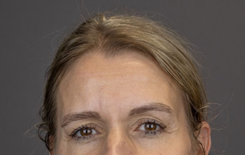 After: Fillers
