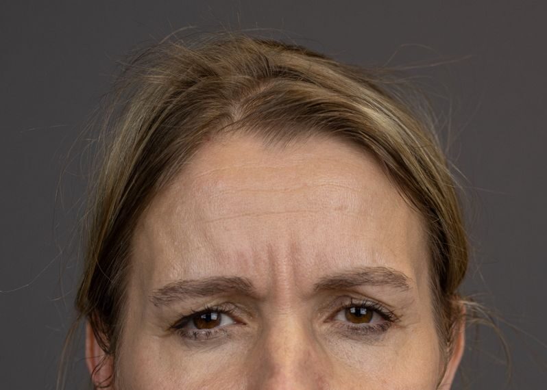 Before: Fillers