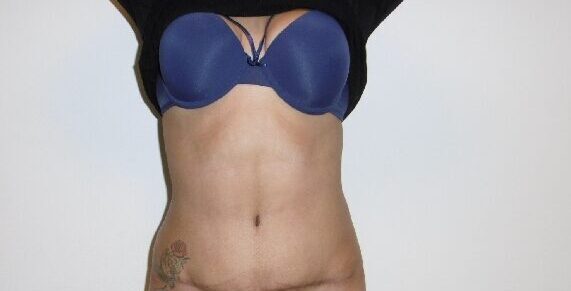 After: Buikwandcorrectie