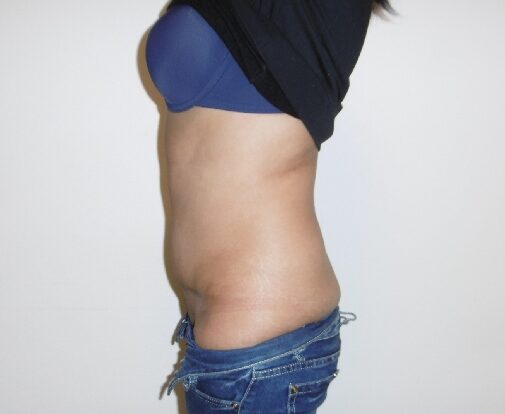 After: Buikwandcorrectie