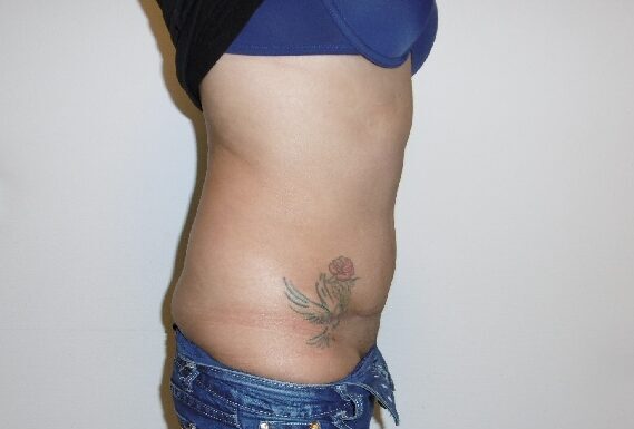 After: Buikwandcorrectie