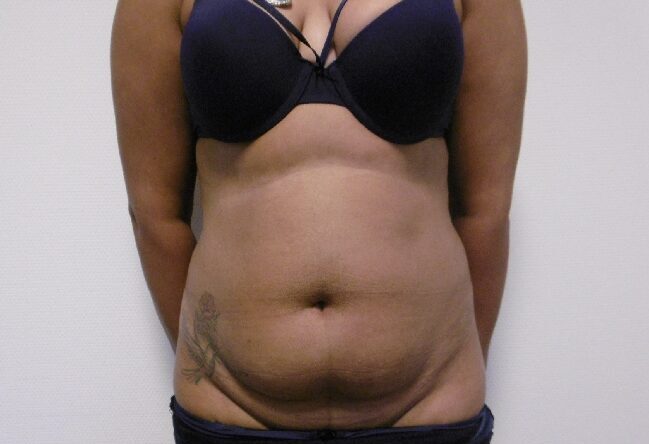 Before: Buikwandcorrectie