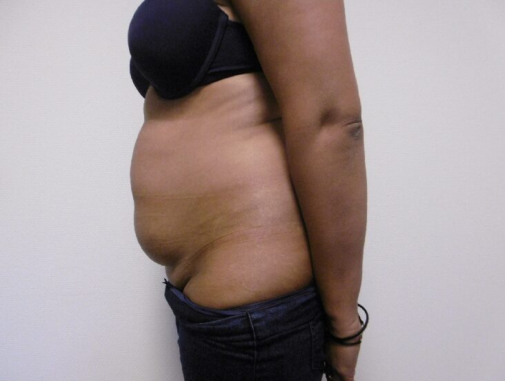 Before: Buikwandcorrectie