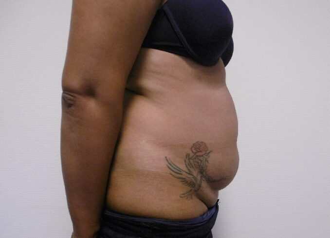 Before: Buikwandcorrectie