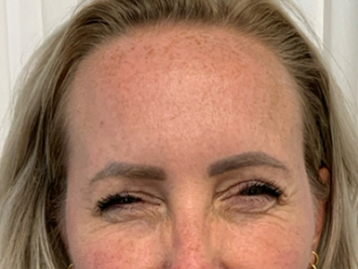 After: Botulinetoxine