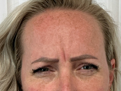 Before: Botulinetoxine
