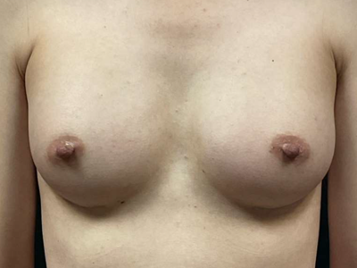 After: Borstvergroting