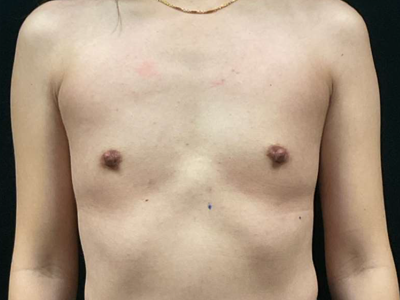Before: Borstvergroting
