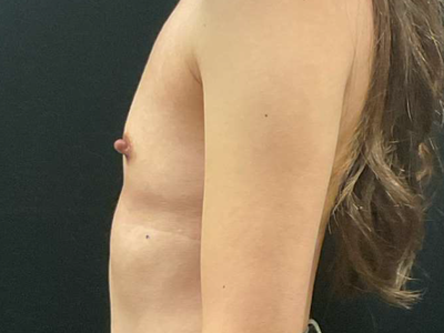 Before: Borstvergroting