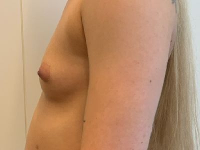 Before: Borstvergroting