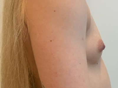 Before: Borstvergroting