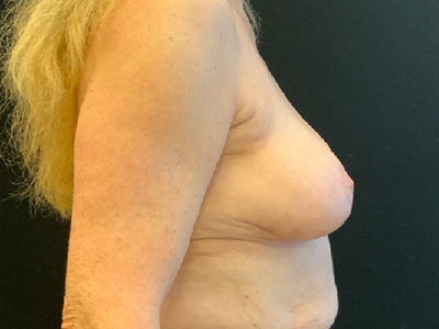 After: Borstverkleining