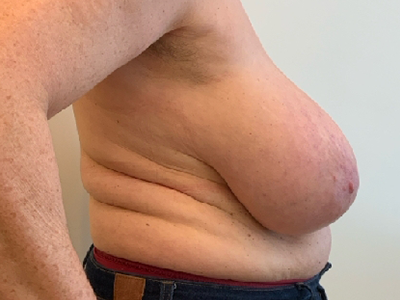 Before: Borstverkleining