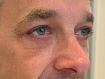 After: Ooglidcorrectie