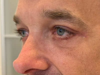 After: Ooglidcorrectie