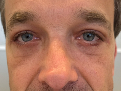 After: Ooglidcorrectie