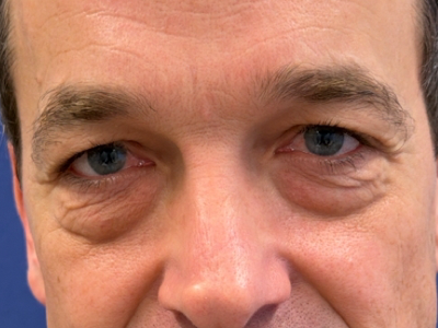 Before: Ooglidcorrectie