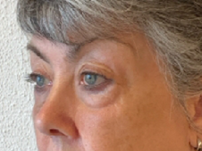 Before: Ooglidcorrectie
