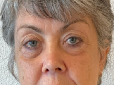 Before: Ooglidcorrectie