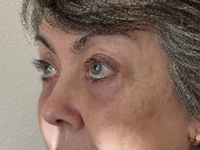 After: Ooglidcorrectie