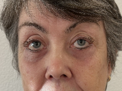 After: Ooglidcorrectie