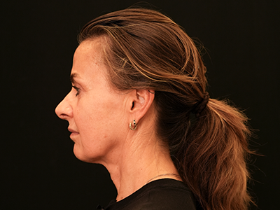 Before: Facelift