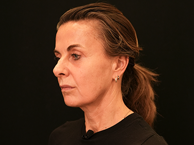 Before: Facelift