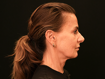 Before: Facelift