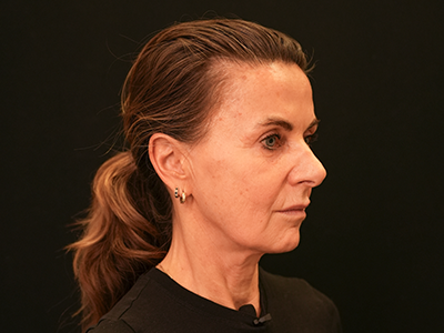 Before: Facelift
