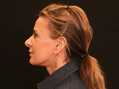 After: Facelift