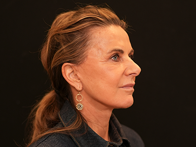 After: Facelift