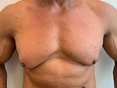 Before: Gynaecomastie
