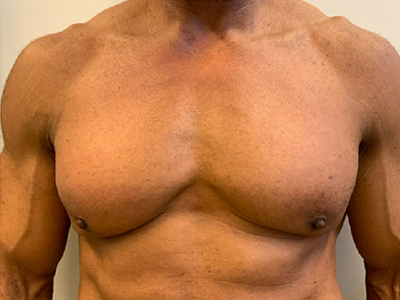 After: Gynaecomastie