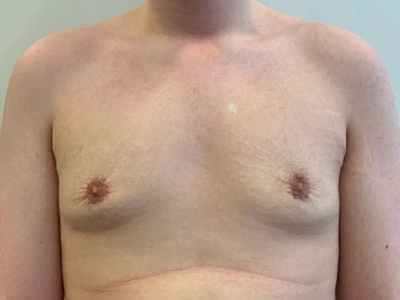 After: Gynaecomastie