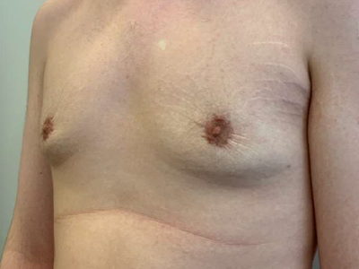 After: Gynaecomastie