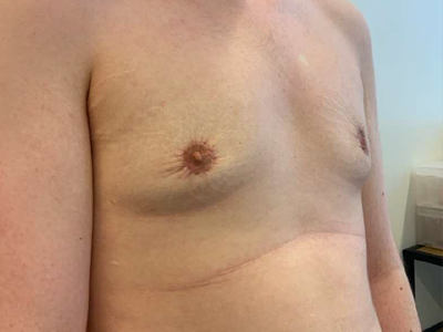 After: Gynaecomastie